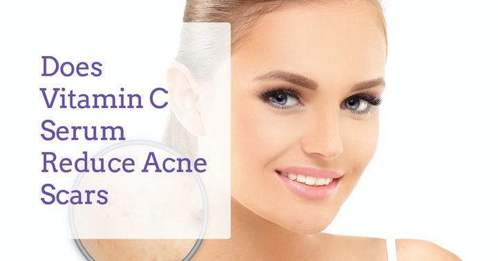 does-vitamin-c-serum-reduce-acne-scars
