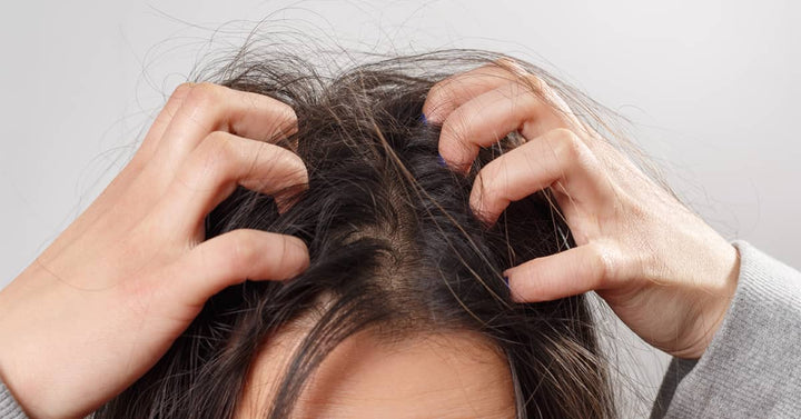 How to Get Rid of Dry and Itchy Scalp During Winters?