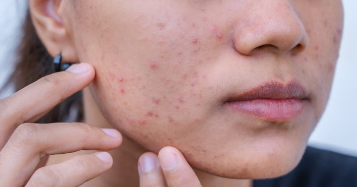 Bacterial Acne vs Hormonal Acne: What's the difference?
