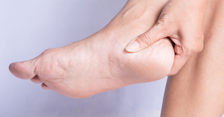 How to heal cracked heels – PHS Africa