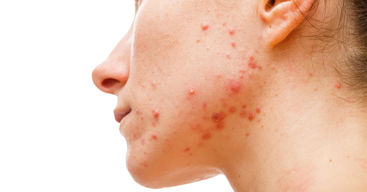 What Is Cystic Acne? How to get rid of cystic acne with top 5 effective treatment