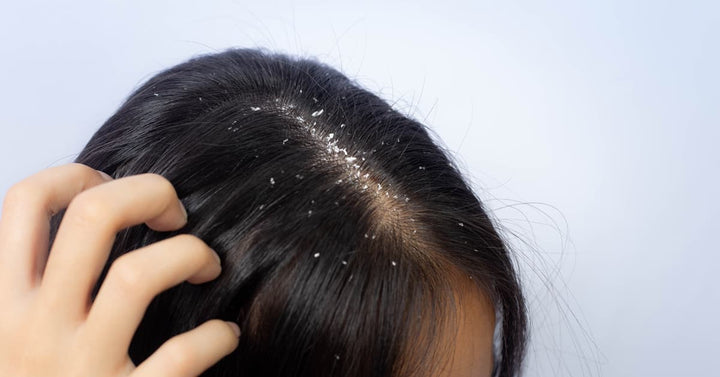 Dry And Itchy Scalp