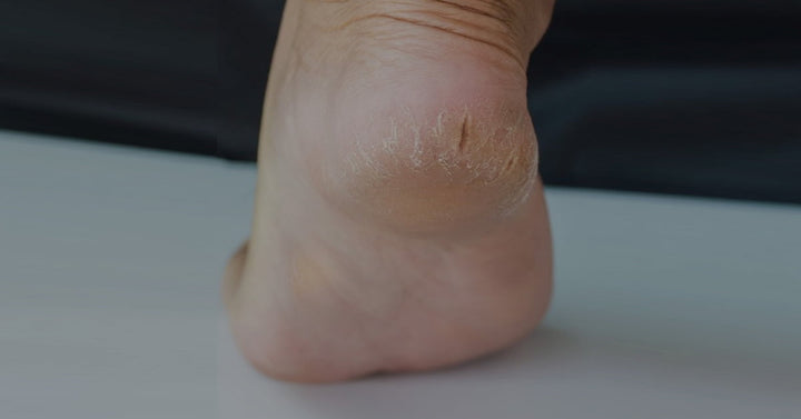 Amazon.com: HelsRx Foot Skin Repair Liquid Bandage, Liquid Skin Repair for Cracked  Heels, Feet, Toes, and Blisters – Waterproof Liquid Treatment for Like New  Foot Skin (0.17 Fl Oz, Skin Buffer Included) :