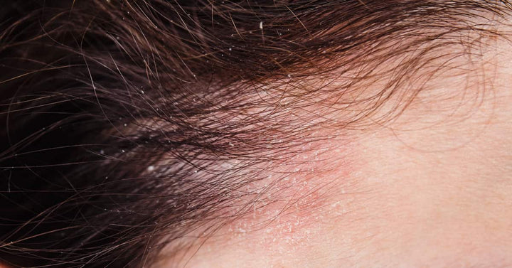 Dry Scalp During Winter