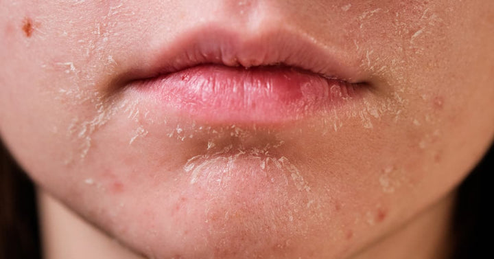Dry Skin Around The Mouth