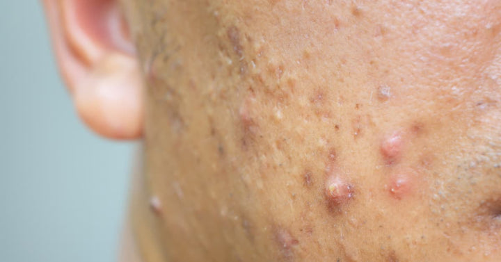 How to identify Nodular Acne and ways to treat it?