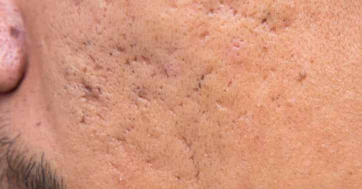 What are the ways to prevent from Pitted Acne Scars?