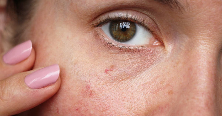 What are the ways to treat your Uneven Skin Texture?