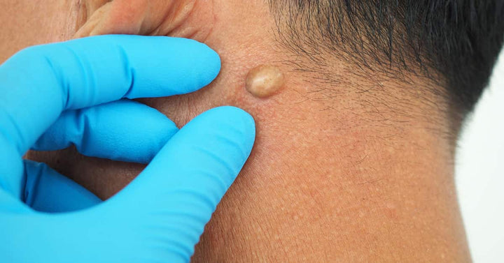 What is sebaceous cyst