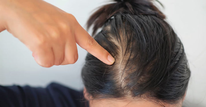 derma-essentia-home-remedies-to-treat-thinning-hair