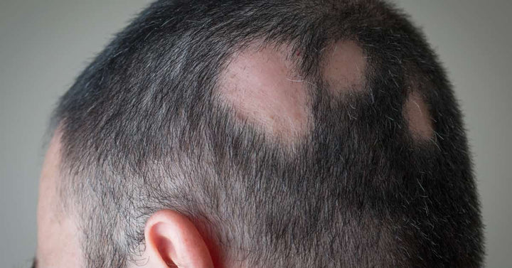 Alopecia-derma-essentia