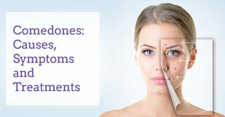 comedones-causes-symptoms-and-treatment-derma