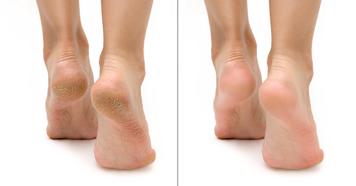 Cracked Heels… OUCH! - Riverside Podiatry