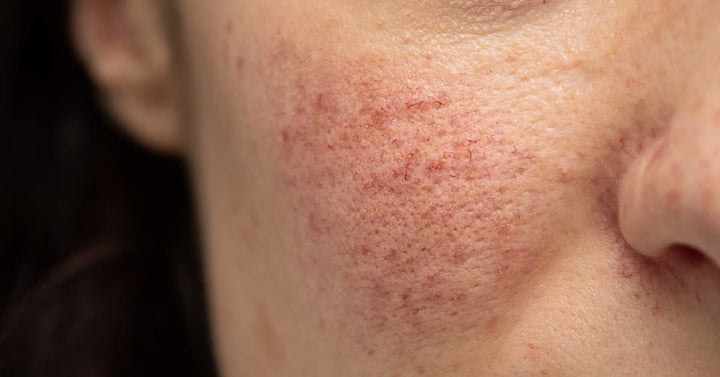What results in Red Blotches and How to manage them?