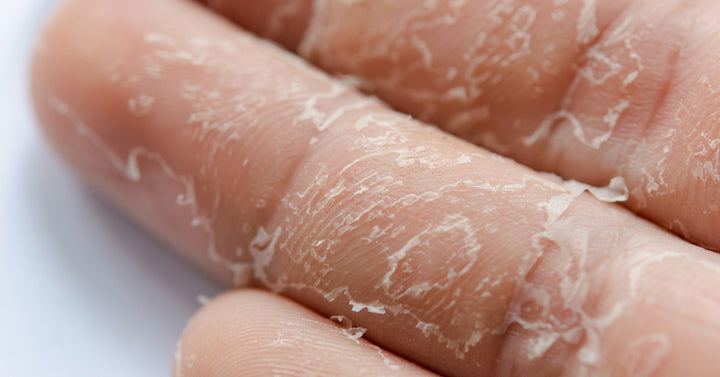 Is your skin peeling on hand?