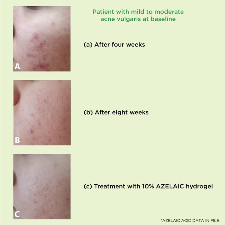 Azelaic acid acne Before after