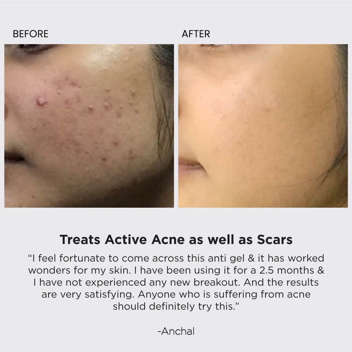Acne Essential Duo Before After