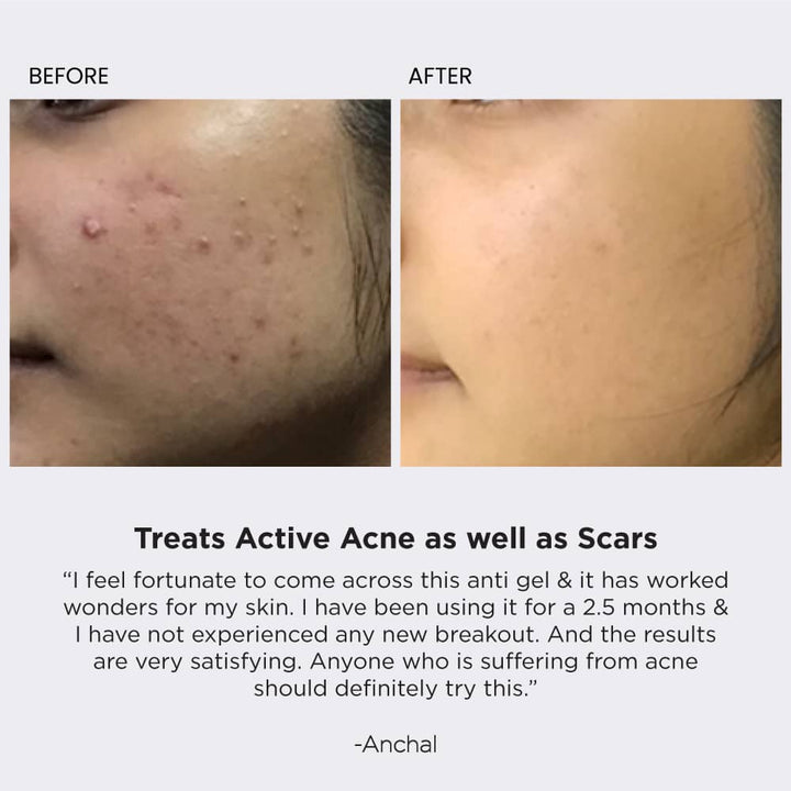 Anti Acne gel Before After